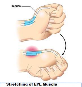 Extensor pollicis longus : Origin,Insertion,Action,Exercise